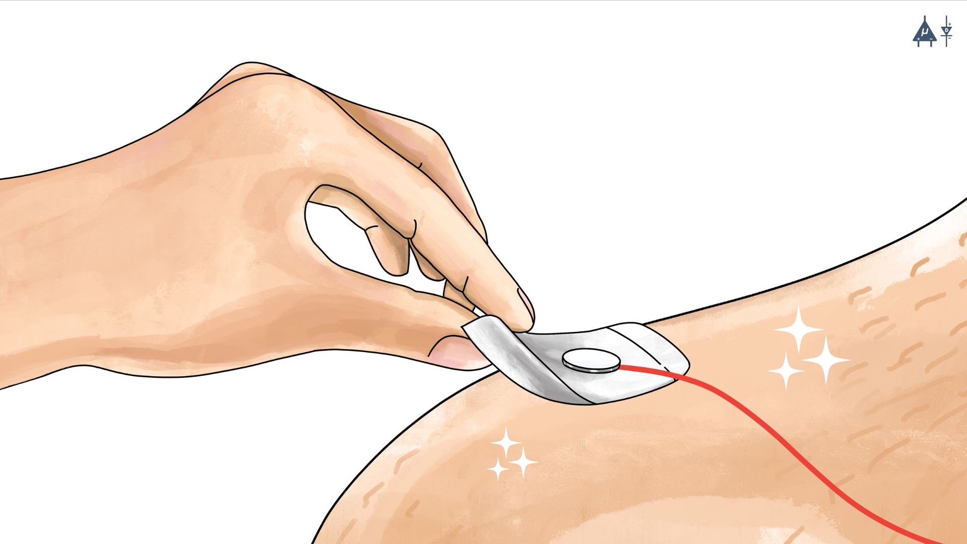 Placing gel electrodes on skin surface